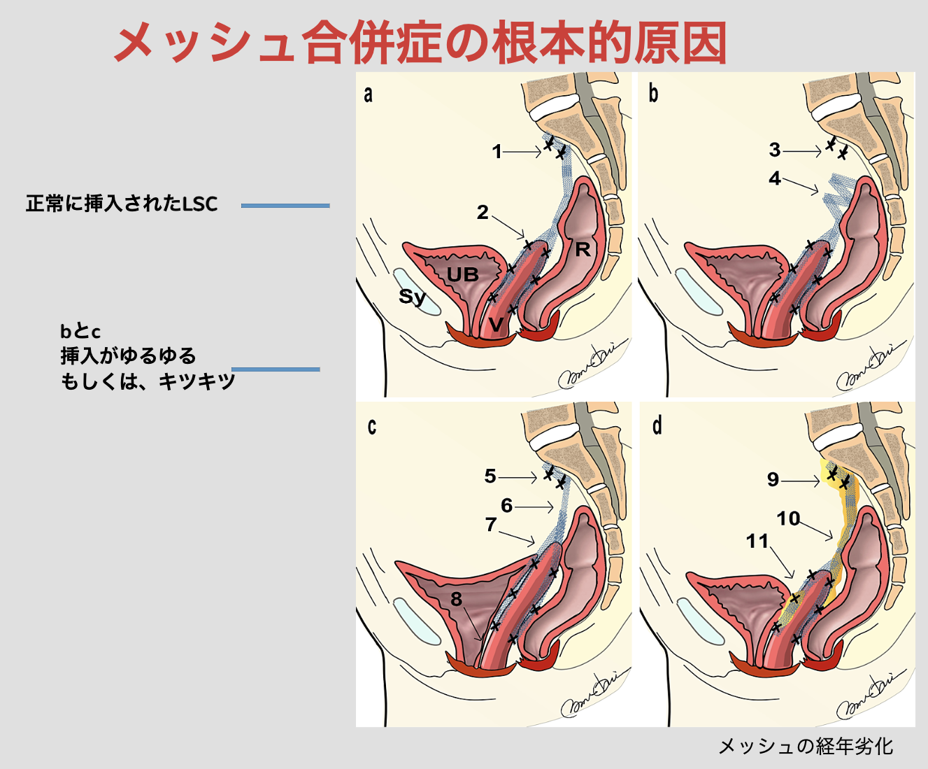 メッシュ合併症。a:正常のイラスト,b:ゆるゆる,c:キツキツ,d:経年劣化